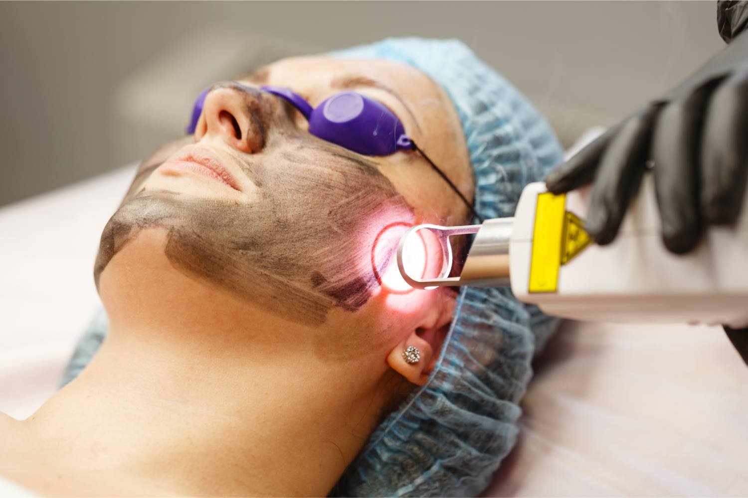 Laser Skin Resurfacing & Rejuvenation Athens, GA