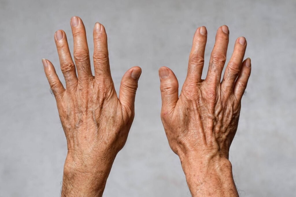 Sun & Age Spot Treatment Athens, GA